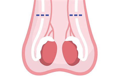 Schéma anatomique expliquant la vasectomie