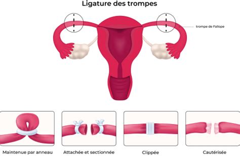 Diagramme comparant la laparoscopie et la minilaparotomie pour la ligature des trompes
