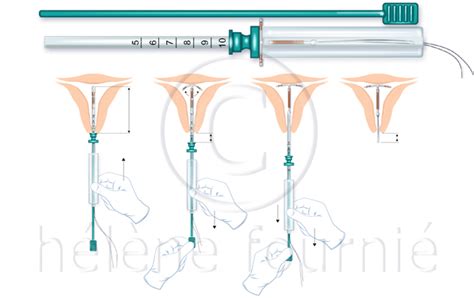 Illustration comparant un DIU au cuivre et un DIU hormonal