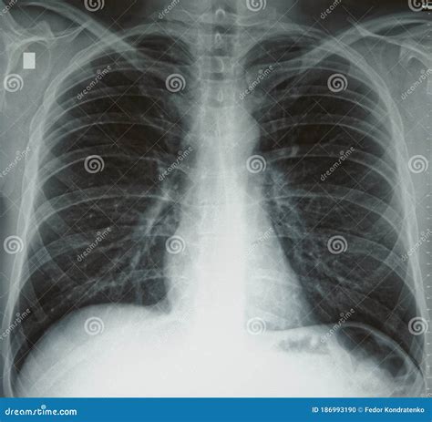 Radiographie thoracique comparant des poumons sains et des poumons atteints de BPCO