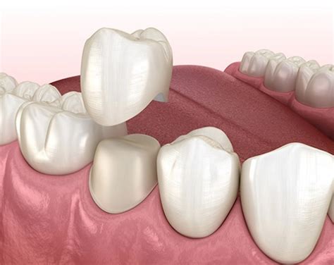 Couronne dentaire E.max monobloc
