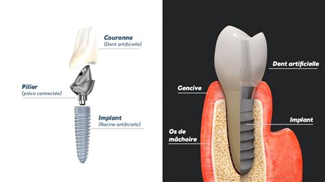 Implant dentaire monobloc