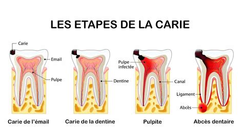 Schéma illustrant la progression d'une carie vers la pulpe dentaire