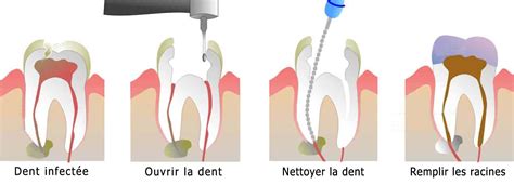 Diagramme montrant les étapes d'un traitement de canal radiculaire