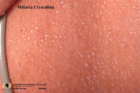 Illustration des différents types de miliaire cutanée : cristalline, rubra, pustuleuse
