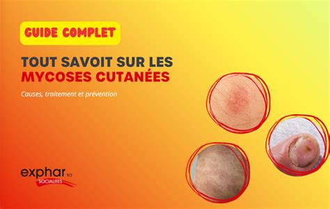 Diagramme expliquant comment les antibiotiques peuvent causer des mycoses