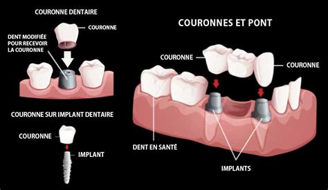 Schéma d'une couronne Richmond monobloc